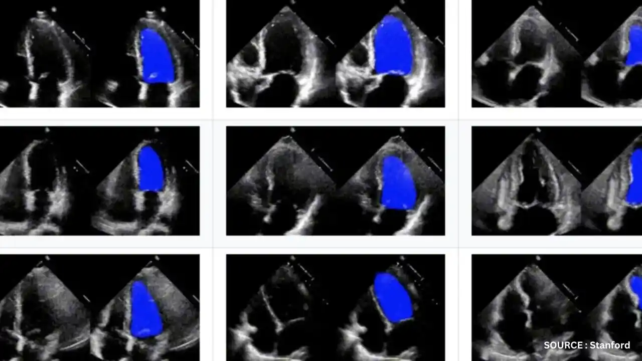 Stanford-developed AI algorithm detects heart abnormalities as effectively as the best cardiologists. 