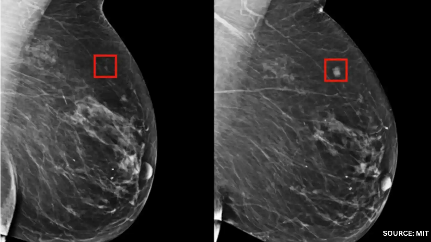 AI in Early Disease Detection, detecting breast cancer 5 years prior